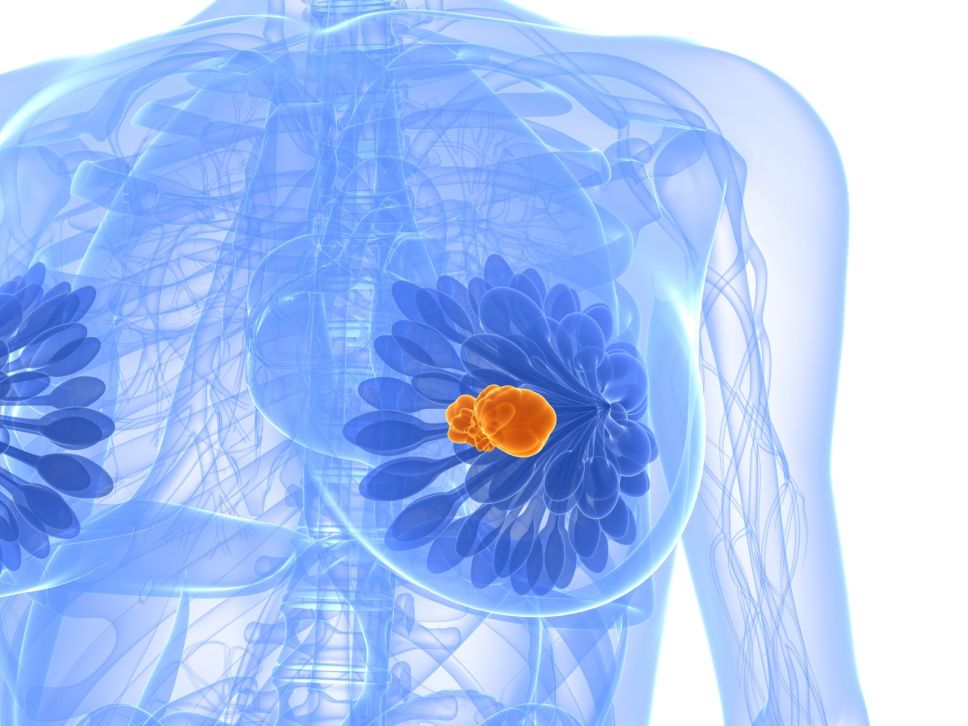 image_of_breast_cancer