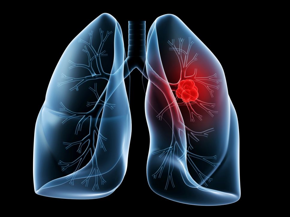 image_of_lung_cancer