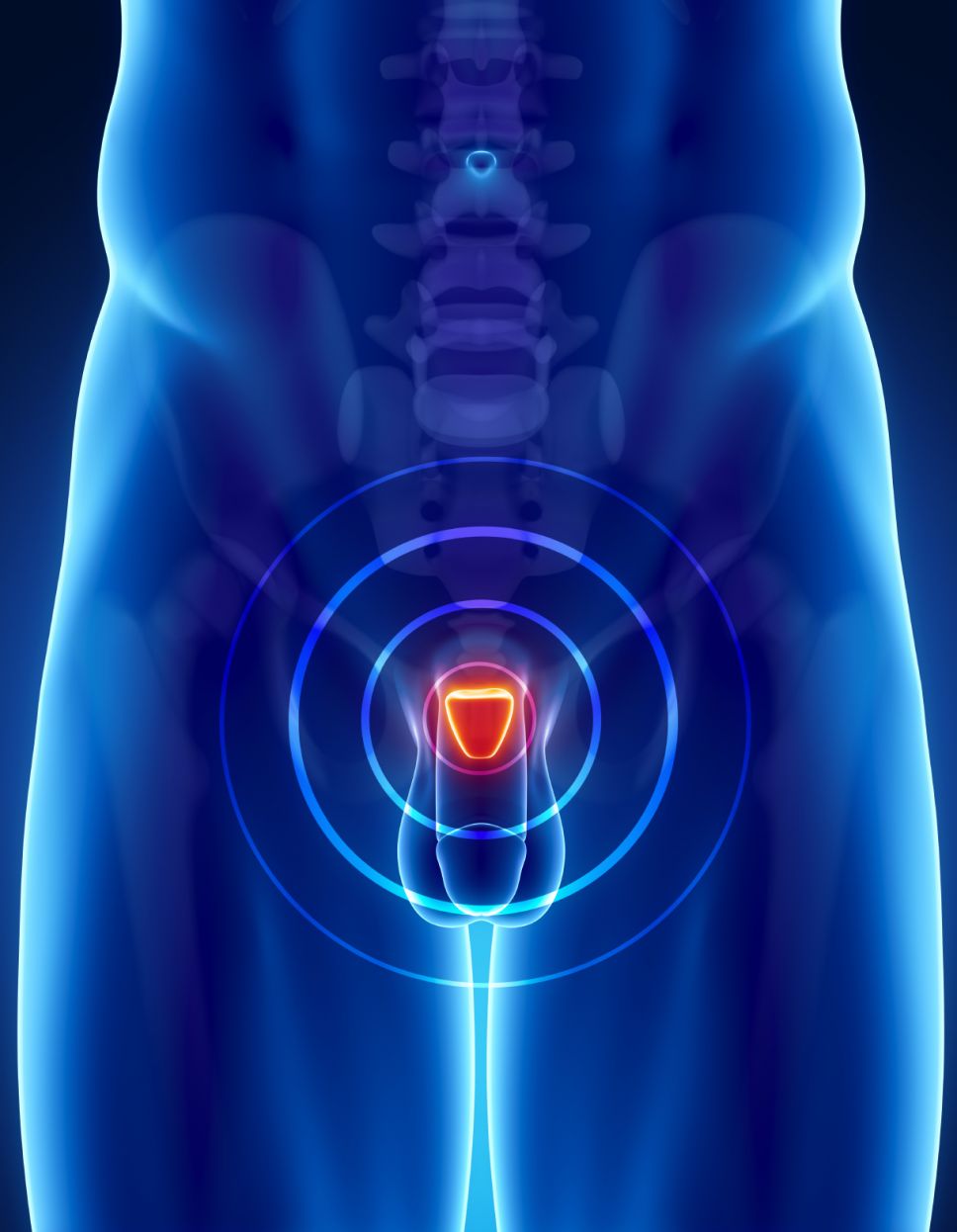 Prostate cancer concept