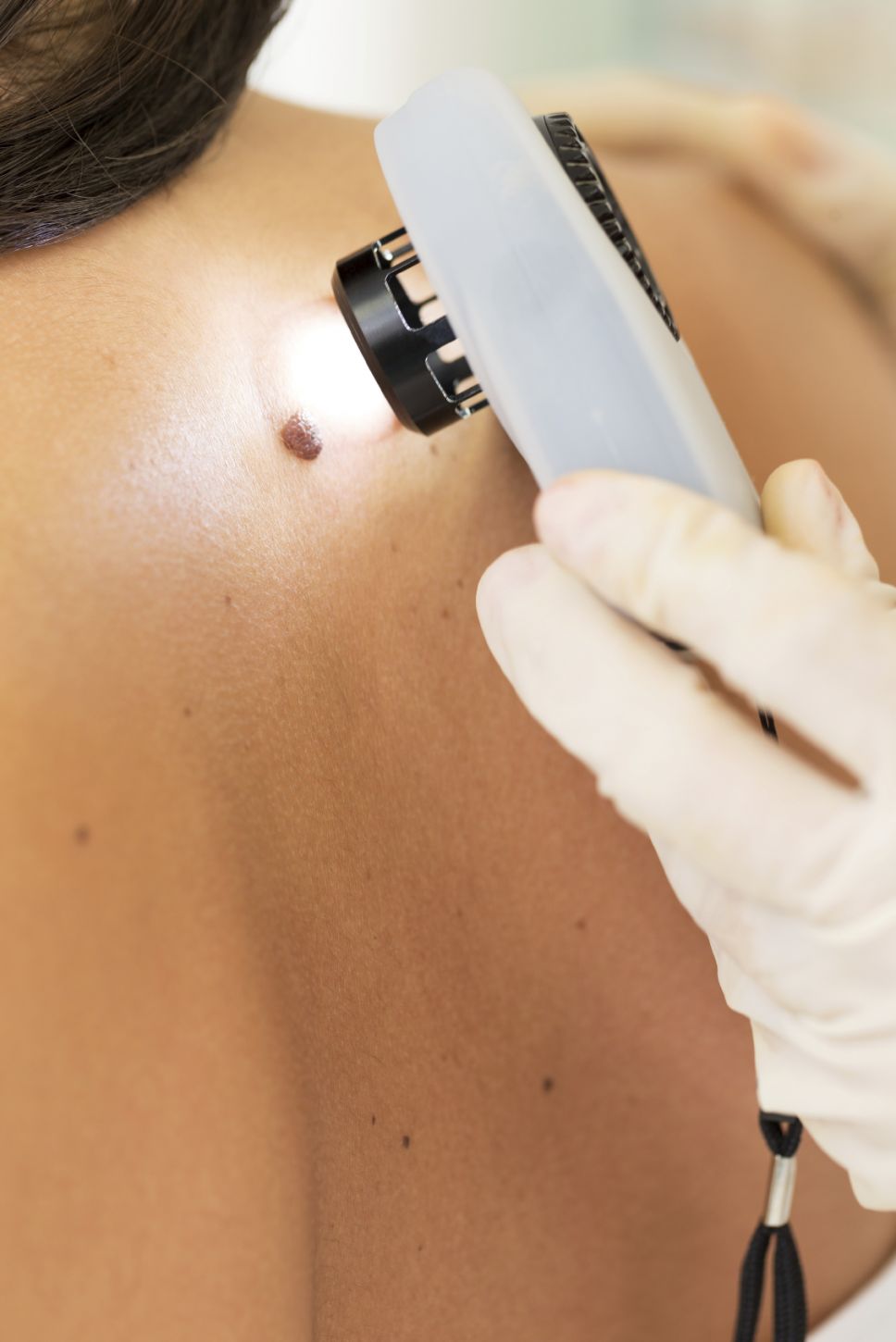 Check for melanoma