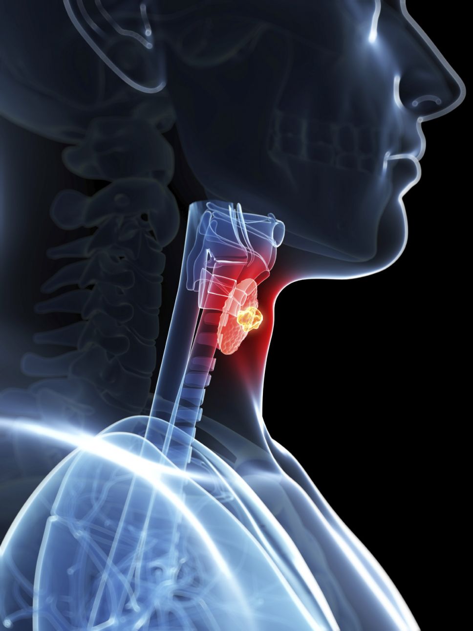 3d rendered illustration of a thyroid cancer