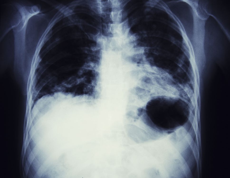 image_of_x-ray_of_lung_cancer