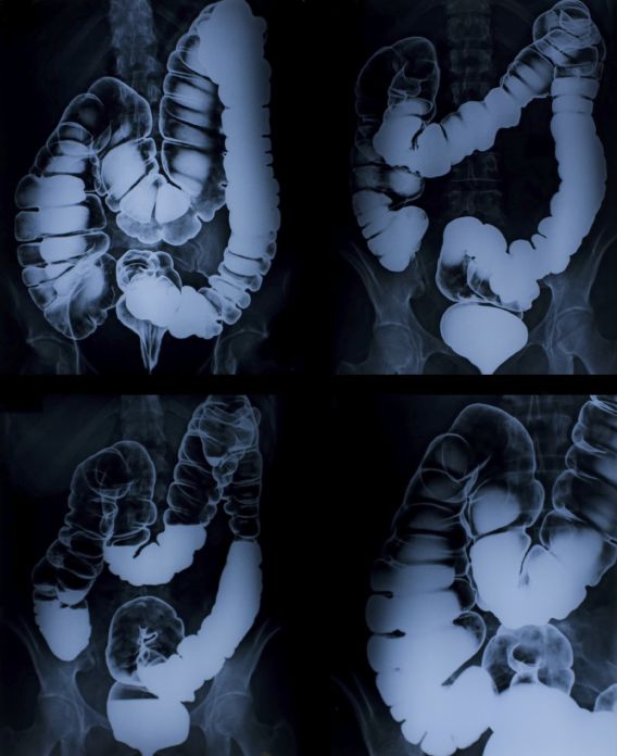 image_of_x-ray_colon